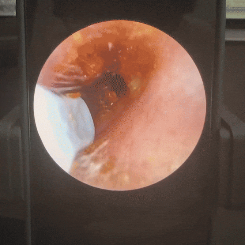 Calynia™:Dispositivo con visione HD per la pulizia delle orecchie